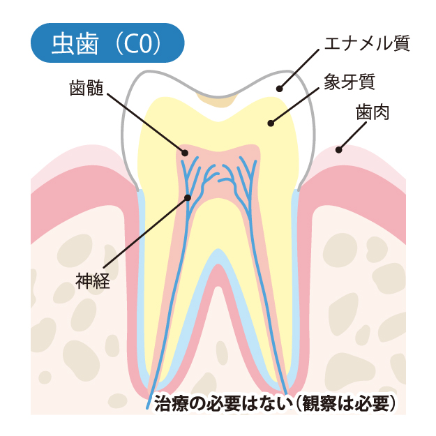 虫歯治療