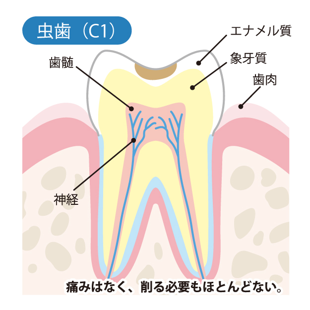 虫歯治療