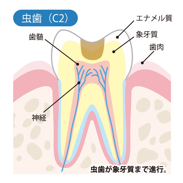 虫歯治療