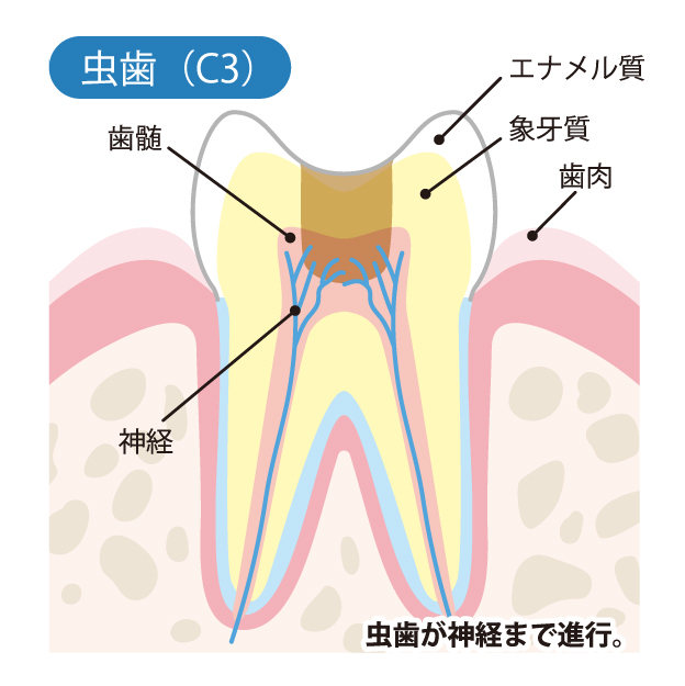 虫歯治療