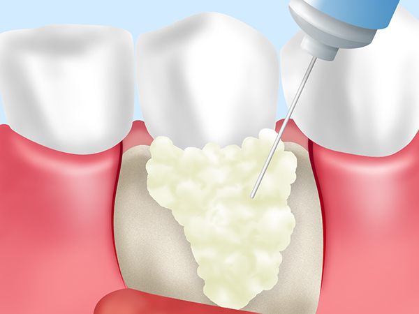 札幌市白石区の歯医者で歯周病治療
