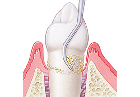札幌市白石区の歯医者で歯周病治療